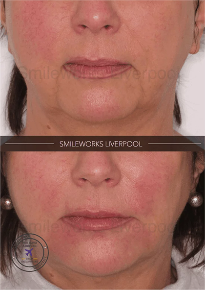 This patient presented wanting an improvement overall with a focus on the lower face.
