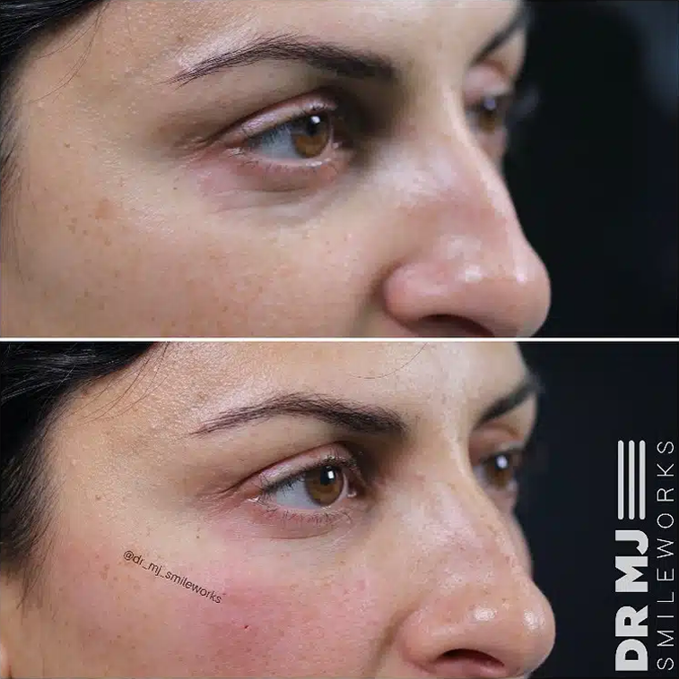 As you age, your tear troughs, the area beneath your lower eyelid and upper cheek, can become dark or sunken in